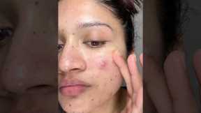 Night skincare routine for acne prone skin