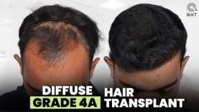 Hair Transplant in Surat (HX-AQWT) | Best Results & Cost of Hair Transplant in Surat