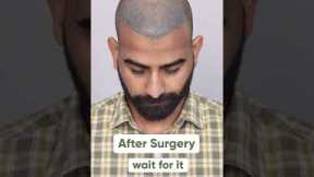 Ten Months Hair Transplant Results | Latest Fue Technique #shorts #viral #hair transplant