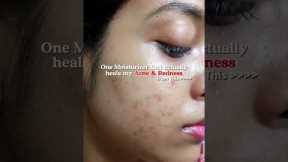 in the caption 👇🏻 Best Moisturizer for Oily Acne-prone Skin for Damaged Skin Barrier, redness, Acne