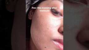 How I repair my dry irritated skin after tretinoin/retinol ✨ #acne #skincaretips #glassskin