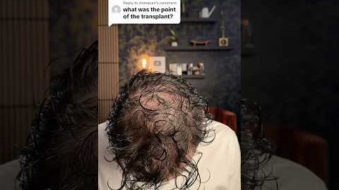 14 months post hair transplant #hair #hairtransformation #hairtransplant #hairgrowth #update