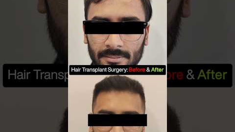 4100 Grafts Hair Transplant | Grade 3 Baldness Before & After Transformation