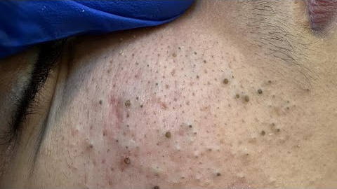 Deep Cleansing Routine | Acne Treatment & Blackhead Removal