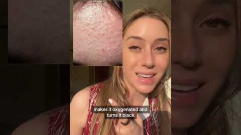 Best Ingredients for Acne Part 1 #shorts