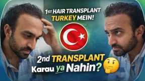 Hair Transplant in Kerala (HX-AWEU) | Best Results & Cost of Hair Transplant in Kerala