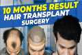 Hair Transplant Time Lapse  |  Step