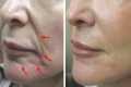 Just 2 skin tightening and face