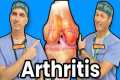Treating Knee Arthritis Without