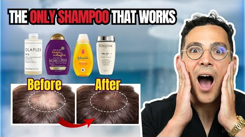 What is the Best Shampoo for Hair Loss? Doctor Reveals the Truth