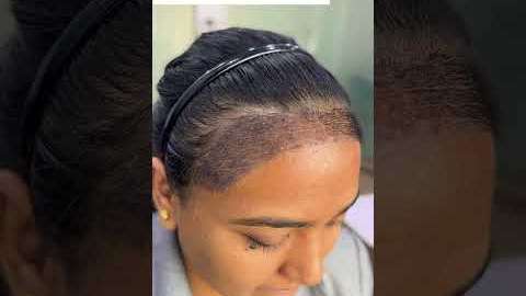 Female Hair Transplant Results | Day-by-Day Progress
