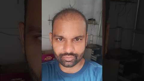 Hair Transplant 2 month result | Day1 to Day 60 Hair Transplant Timelapse | Rajan Singh