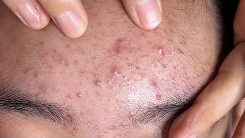 ASMR Deep Facial Cleansing & Blackhead Removal#acne 