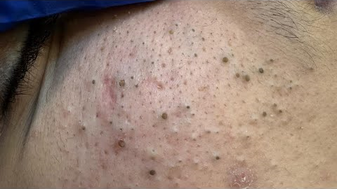 ULTIMATE Blackhead Removal Routine | Korean Facial Care Solutions