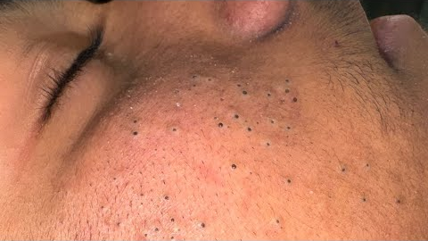 [ASMR] Clear Skin Therapy: Deep Cleansing and Pore Care