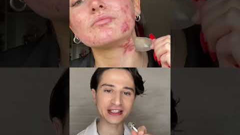 Pimple Patch Secret. #dermreacts #acne #skincare