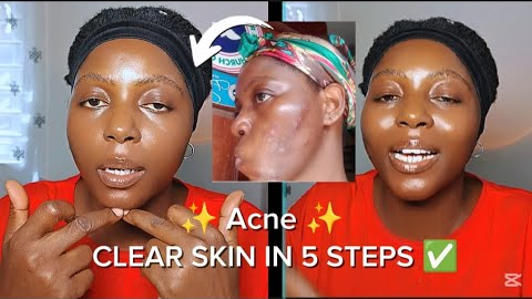 MY UPDATED SKINCARE ROUTINE (Unsponsored skincare routine for acne  )