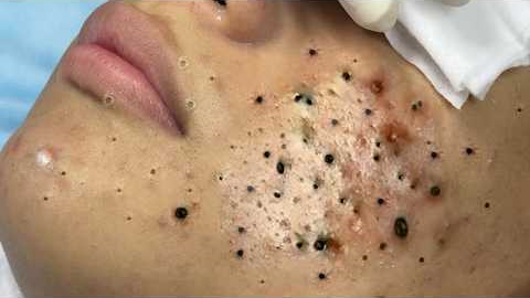 Calm Skincare Routine – Gentle Blackhead and Acne Cleaning - 219084