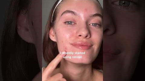 How RETINOL PURGE can look 🫣💖#acnetreatment #acne #acnetips #skincare #skintips #retinol