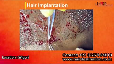 Hair Transplant Before & After Results | Real Patient Transformation | Natural Hair Regrowth