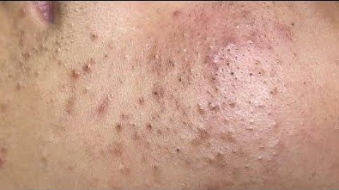 acne treatment deep pore cleansing & blackhead extraction[ASMR]