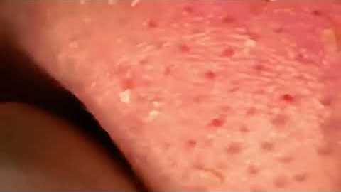 Deep Blackhead Extraction on the Nose | Relaxing ASMR Skin Care