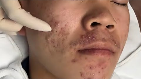 ASMR Acne Treatment | Extreme Blackhead Removal & Skin Cleaning#asmr 