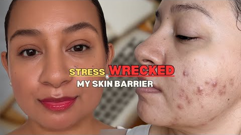 Stress is Destroying Your Skin Barrier (My Mistake)