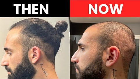 Bald after 2 Hair Transplants!