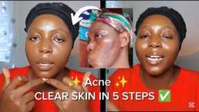 MY UPDATED SKINCARE ROUTINE (Unsponsored skincare routine for acne  )