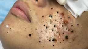 Calm Skincare Routine – Gentle Blackhead and Acne Cleaning - 219084