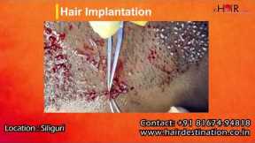 Hair Transplant Before & After Results | Real Patient Transformation | Natural Hair Regrowth