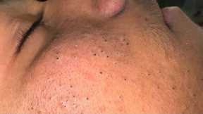 Tranquil Skin Therapy ASMR — Effective Solutions for Blackheads and Acne