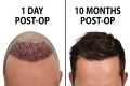 What a Hair Transplant Looks Like -