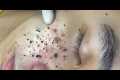 Deep Pore Blackhead Removal –