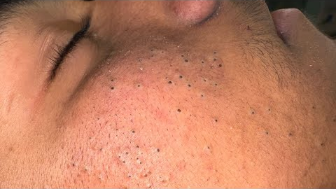 Deep Blackhead Removal & Pimple Treatment | Ultimate Facial Care Routine