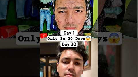 My Acne Journey | 1 Month Pimple Cure | I Cleared My Acne Only In 30 Days #acne #pimple #skincare