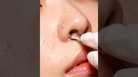 Pure Glow ASMR | Gentle Whitehead Extraction & Deep Skin Cleaning Therapy 🌿💆‍♀️😌 #cleansingsoap