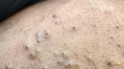 ASMR Facial Care Routine for Acne-Free Skin - Deep Cleansing & Natural Remedies