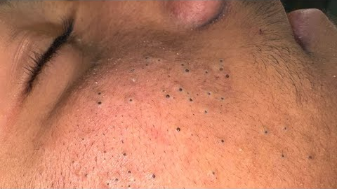 ASMR Facial Care Routine for Clear Skin - Deep Cleansing, Blackhead Removal & Pimple Treatment