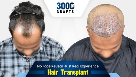 Grade 3 Hair Transplant in India | Hair Transplant Results & Cost in India #hairtransformation