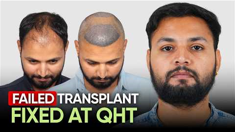 Hair Transplant in Mumbai (HX-QAGG) | Best Results & Cost of Hair Transplant in Mumbai.