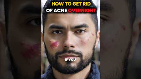 Get Rid of acne OVERNIGHT