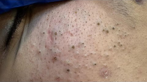 ASMR Facial Care Routine - Deep Cleansing, Pimple Treatment, and Blackhead Removal