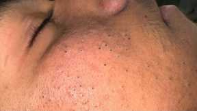 Deep Blackhead Removal & Pimple Treatment | Ultimate Facial Care Routine