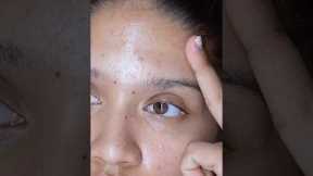 Night skincare routine for acne-prone skin when my skin is breaking out.