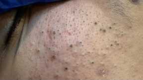 ASMR Facial Care Routine - Deep Cleansing, Pimple Treatment, and Blackhead Removal