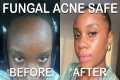 fungal acne safe skincare routine