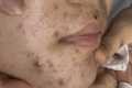 pimple popper blackhead remove,#001 