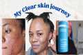 BEST ACNE skincare products... How I